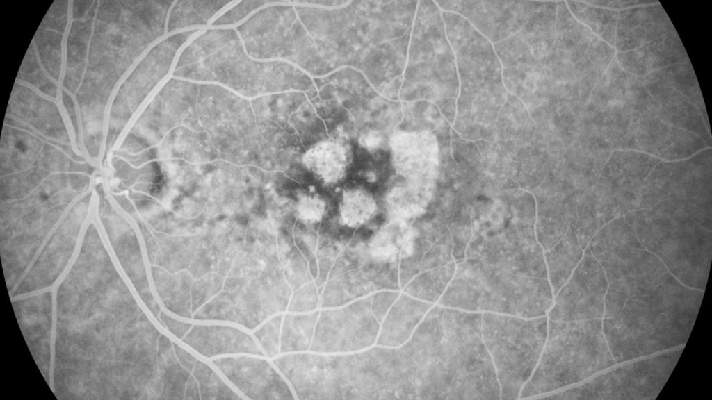 Angiografia fluorescente