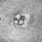 Angiografia fluorescente